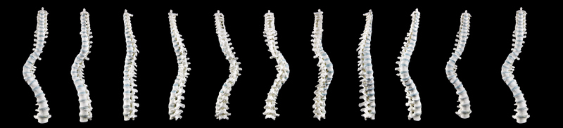 spinalcurvature